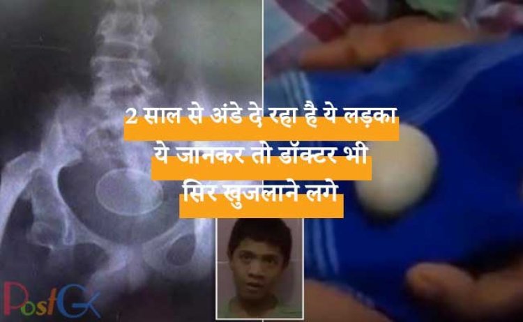 2 साल से अंडे दे रहा है ये लड़का, ये जानकर तो डॉक्टर भी सिर खुजलाने लगे